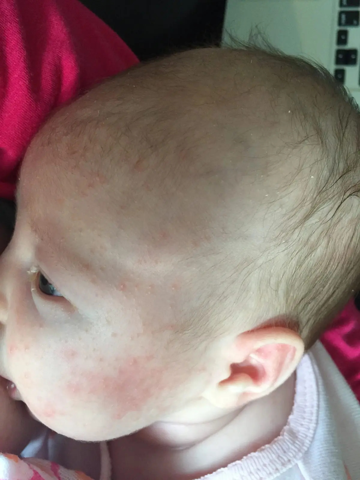 Newborn Skin Rash What's that on your newborn's face?