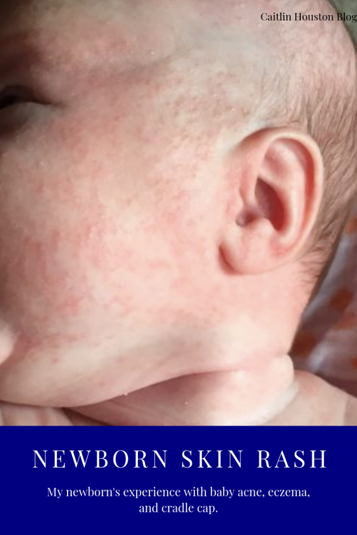 Newborn Skin Rash What's that on your newborn's face?