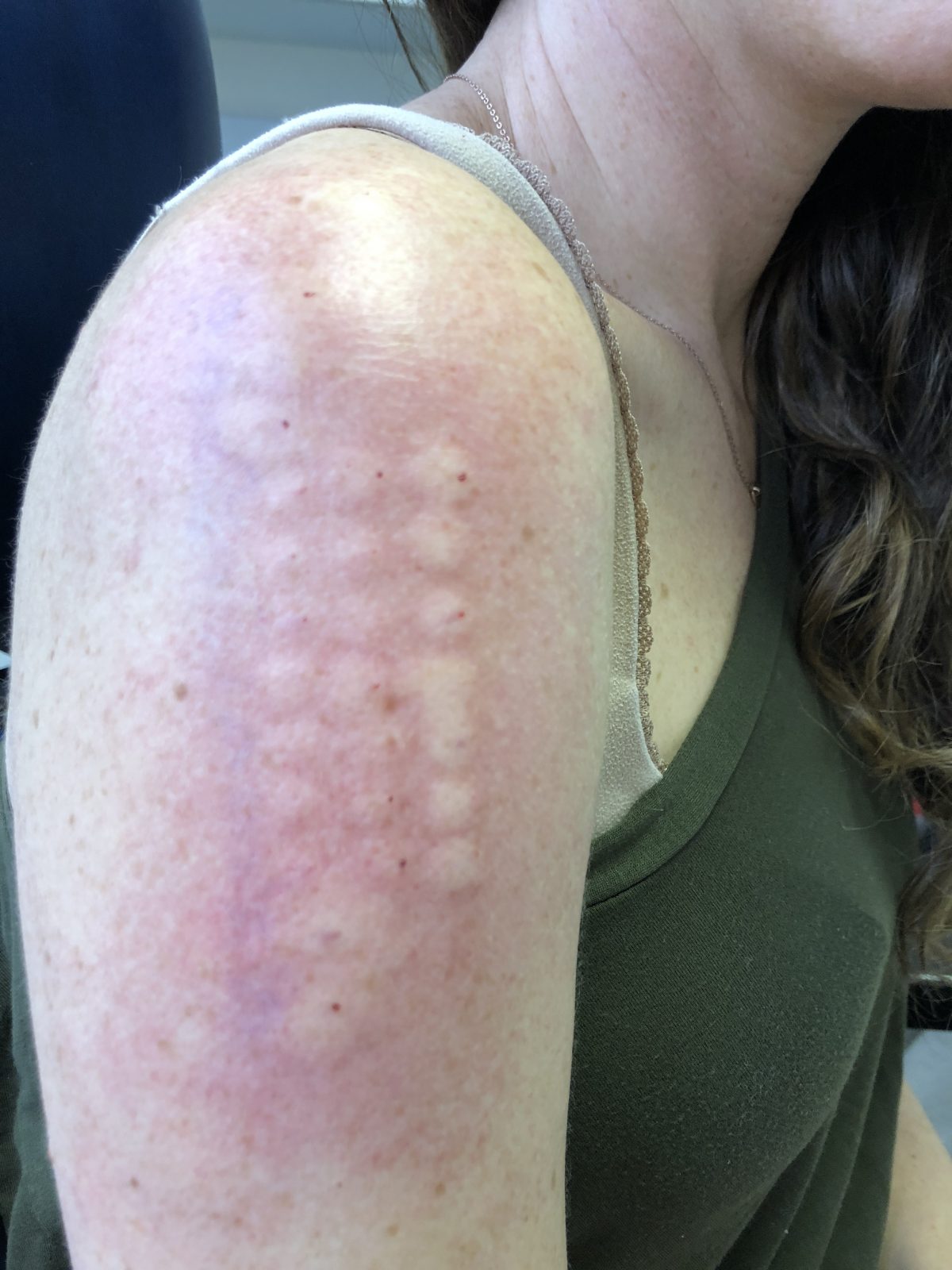 Allergy Testing Results on an Arm