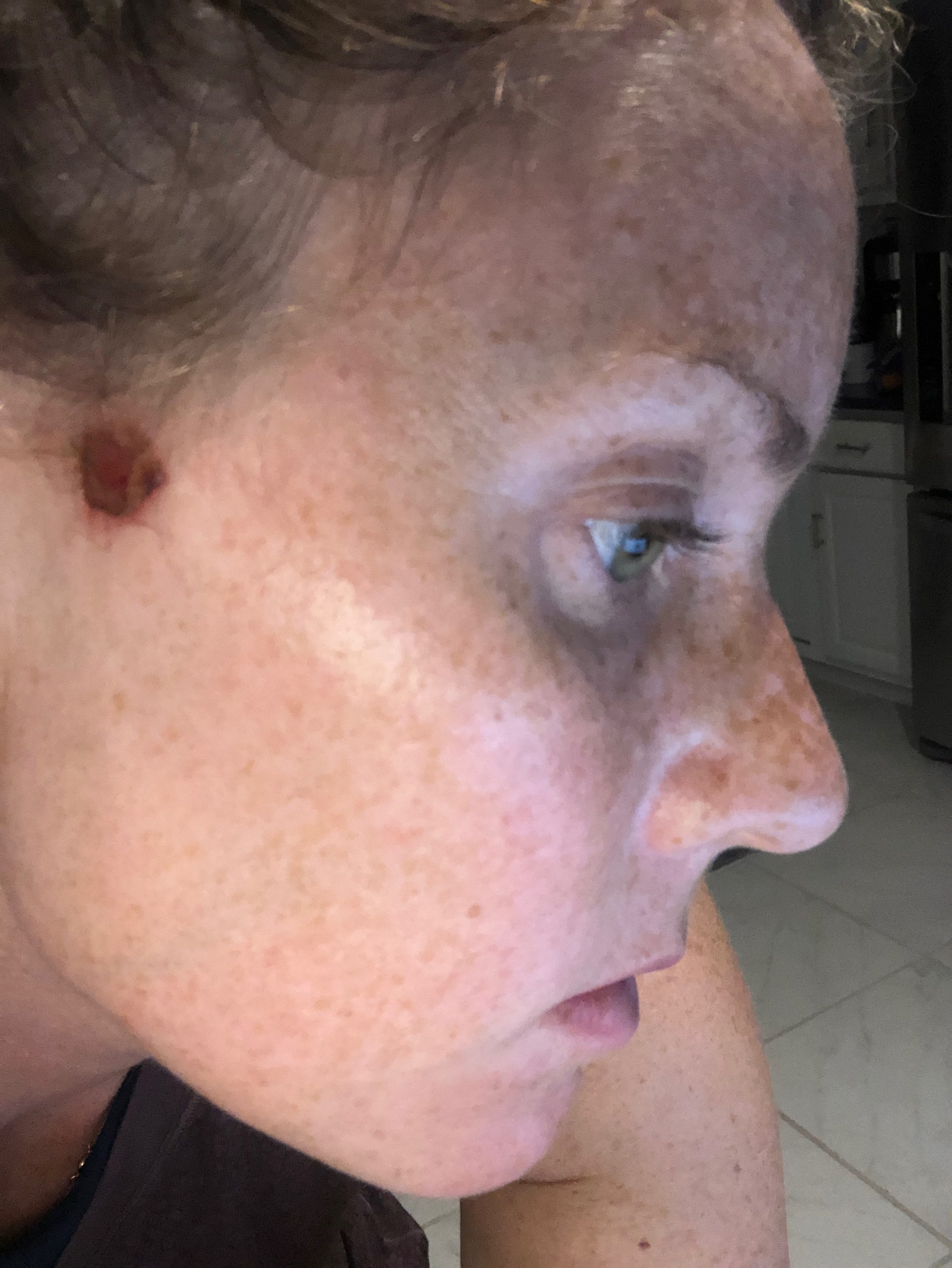 Woman with Basal Cell Carcinoma Skin Cancer on face