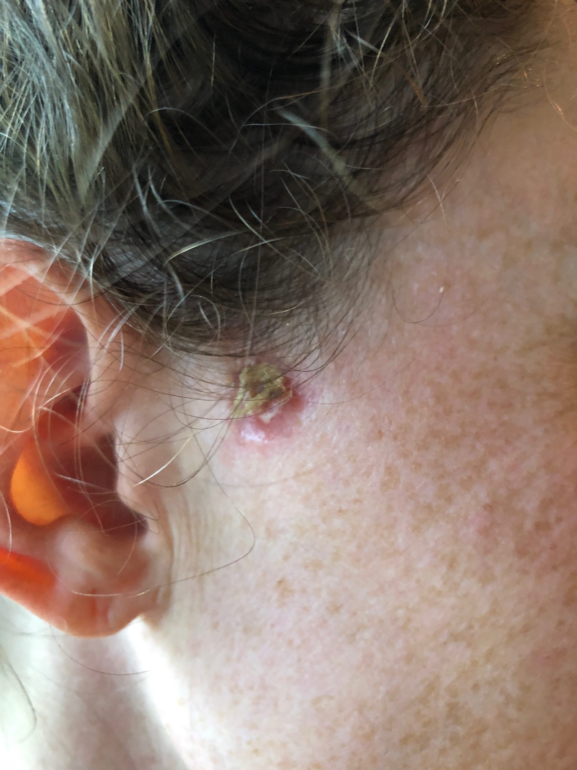 woman with skin cancer healing