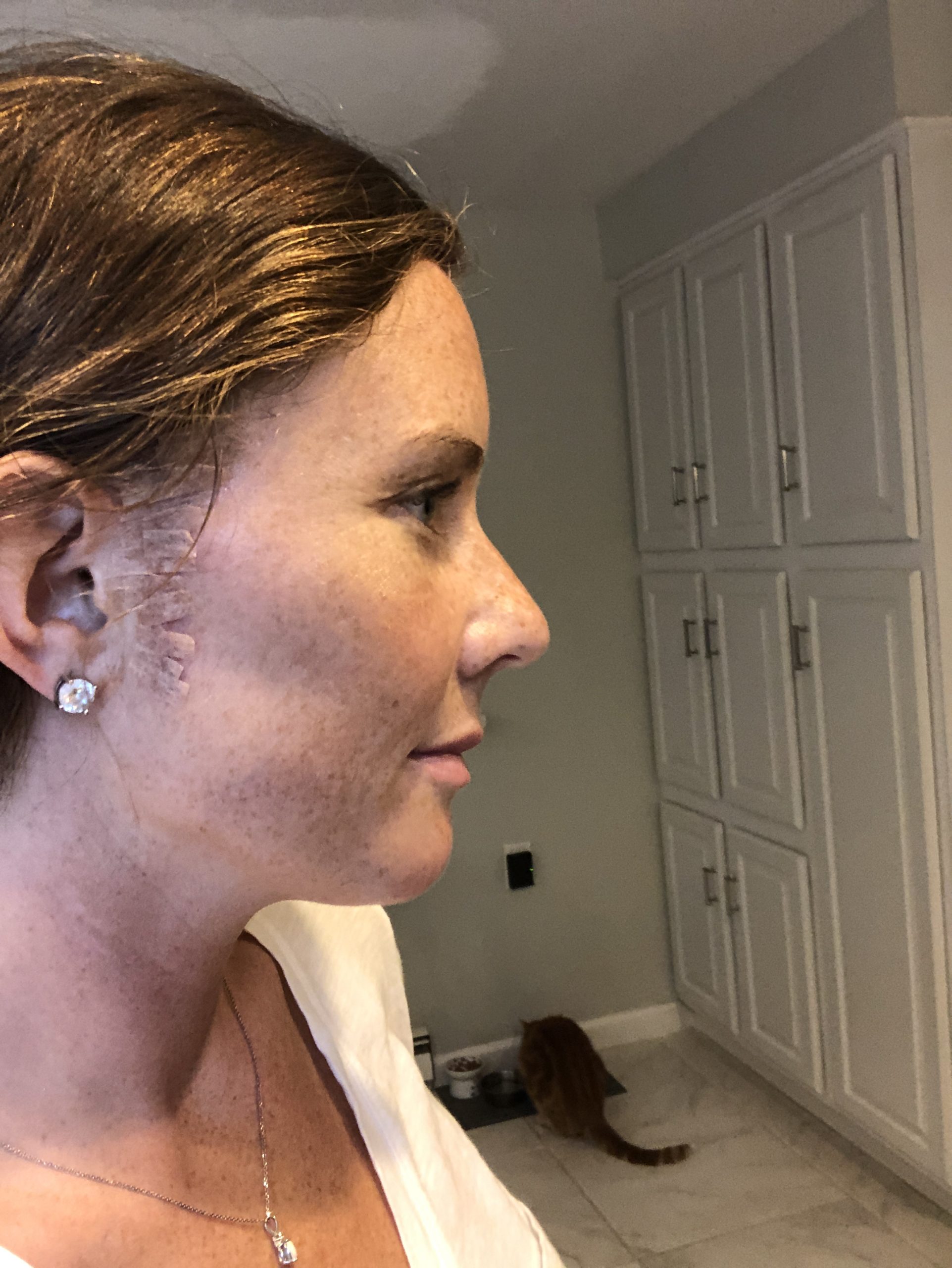 Steri Strips on Scar after stitches removal from Mohs Surgery on face