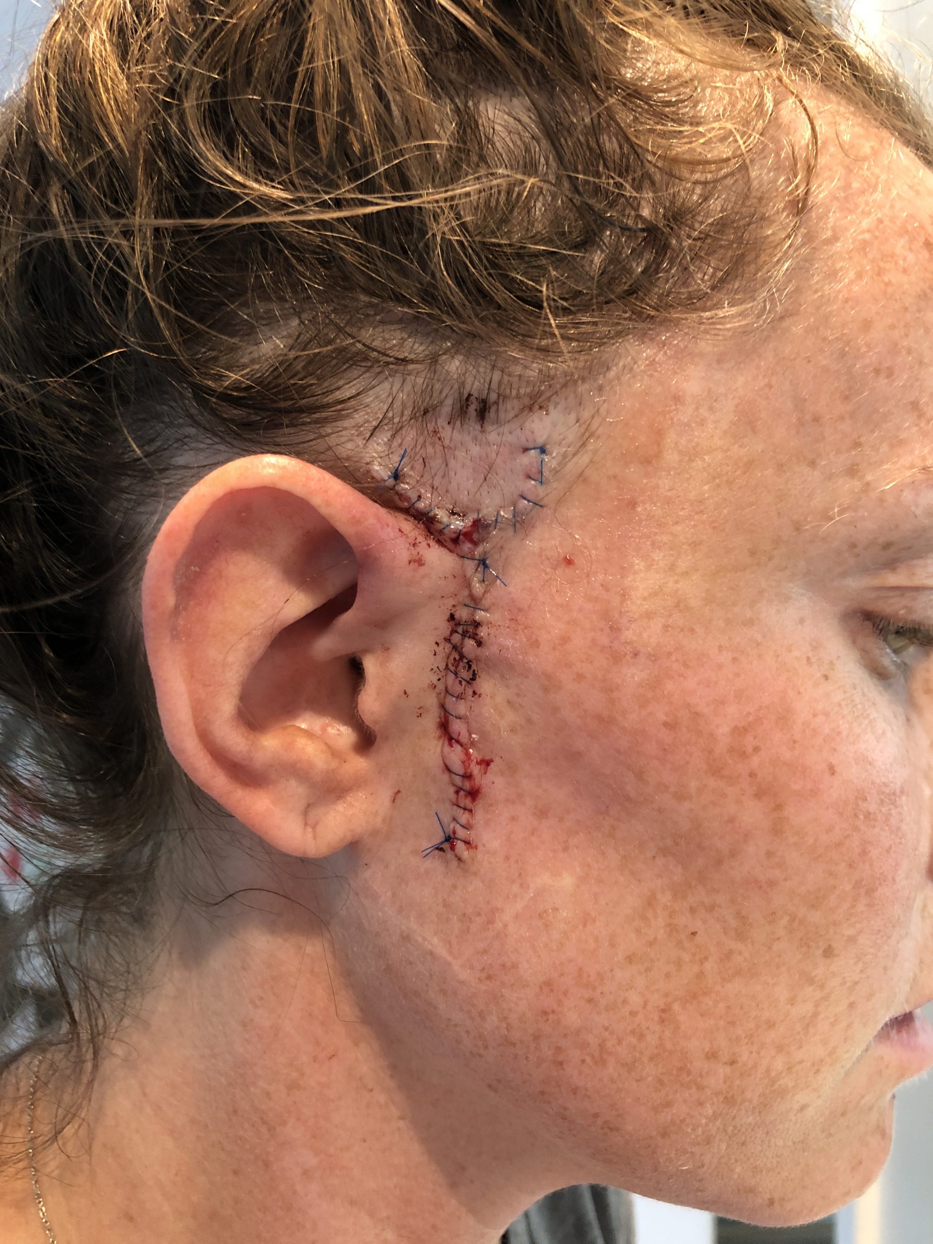 Mohs Surgery Scar with stitches