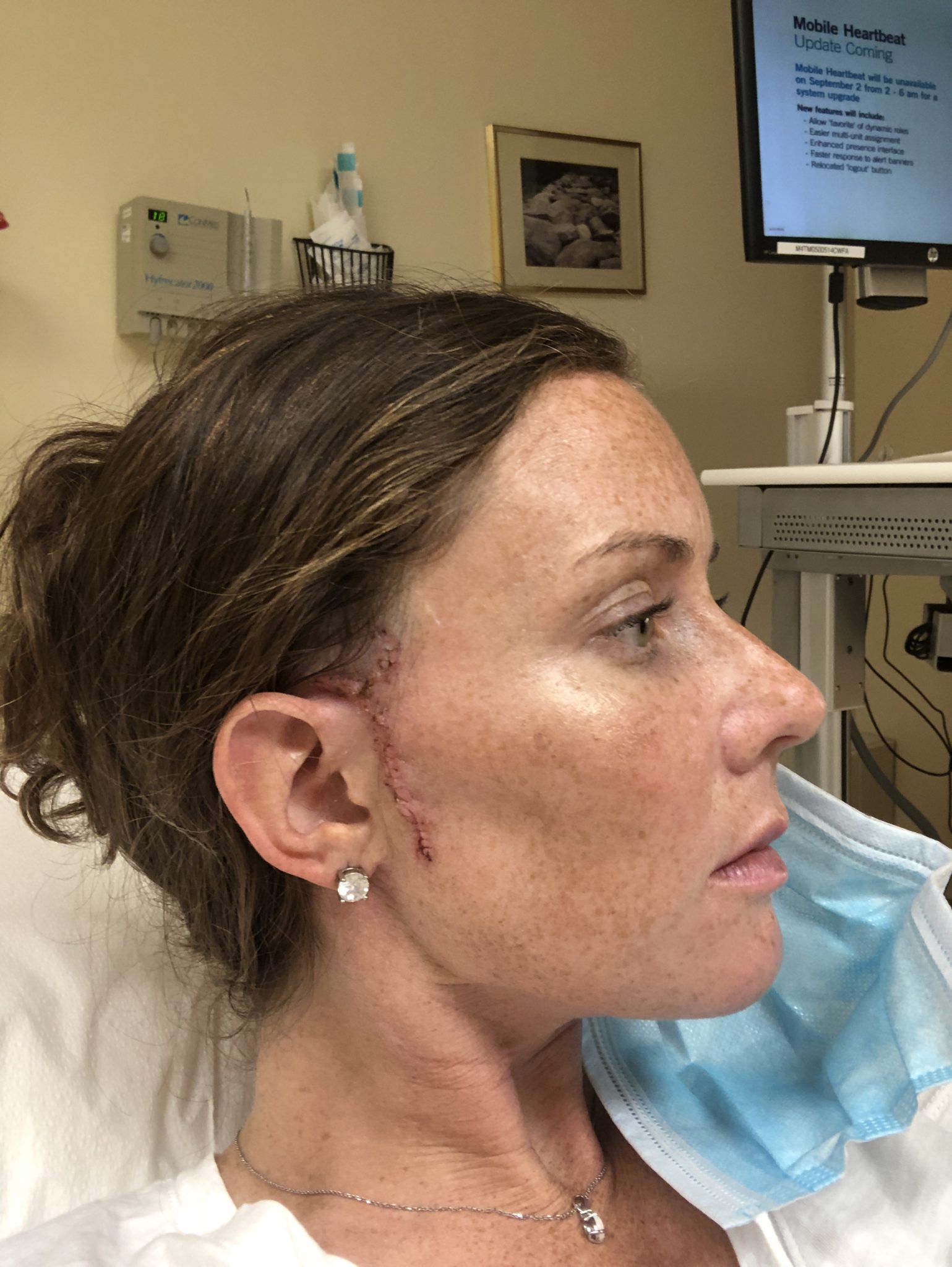My Mohs Surgery Experience for Basal Cell Carcinoma Caitlin Houston