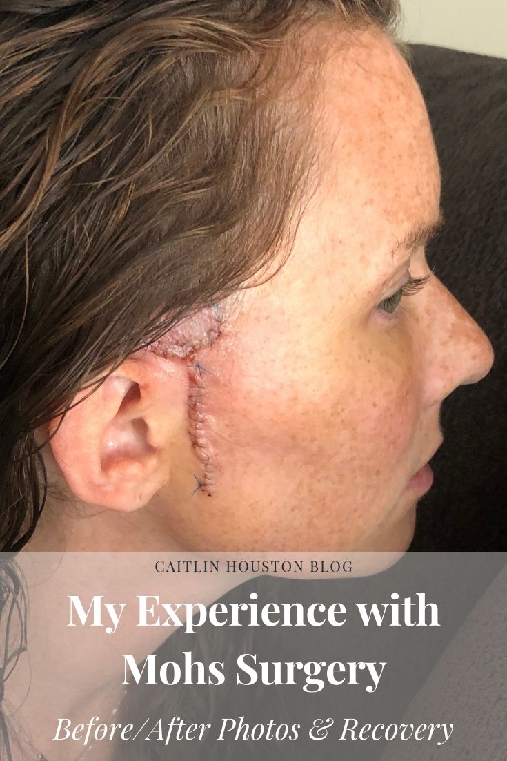 Mohs Surgery for Basal Cell Carcinoma with Before and After Surgery Photos 