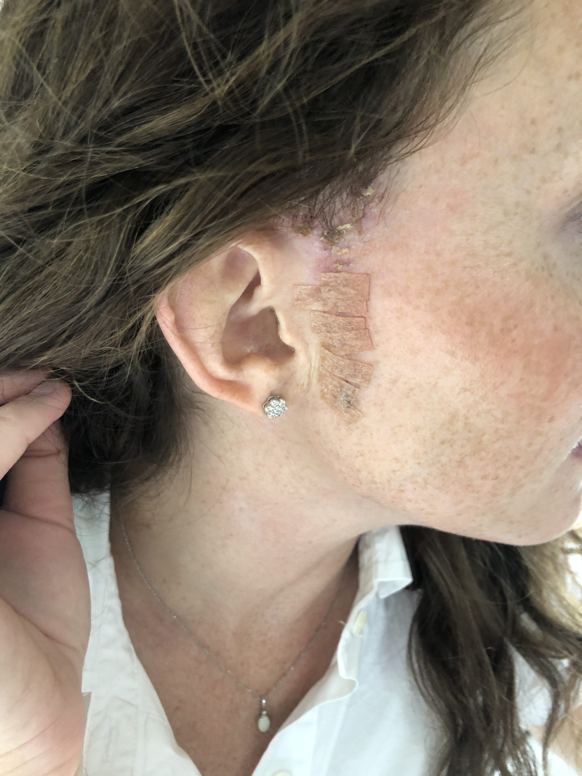 Steri strips falling off scar from Mohs Surgery on Face