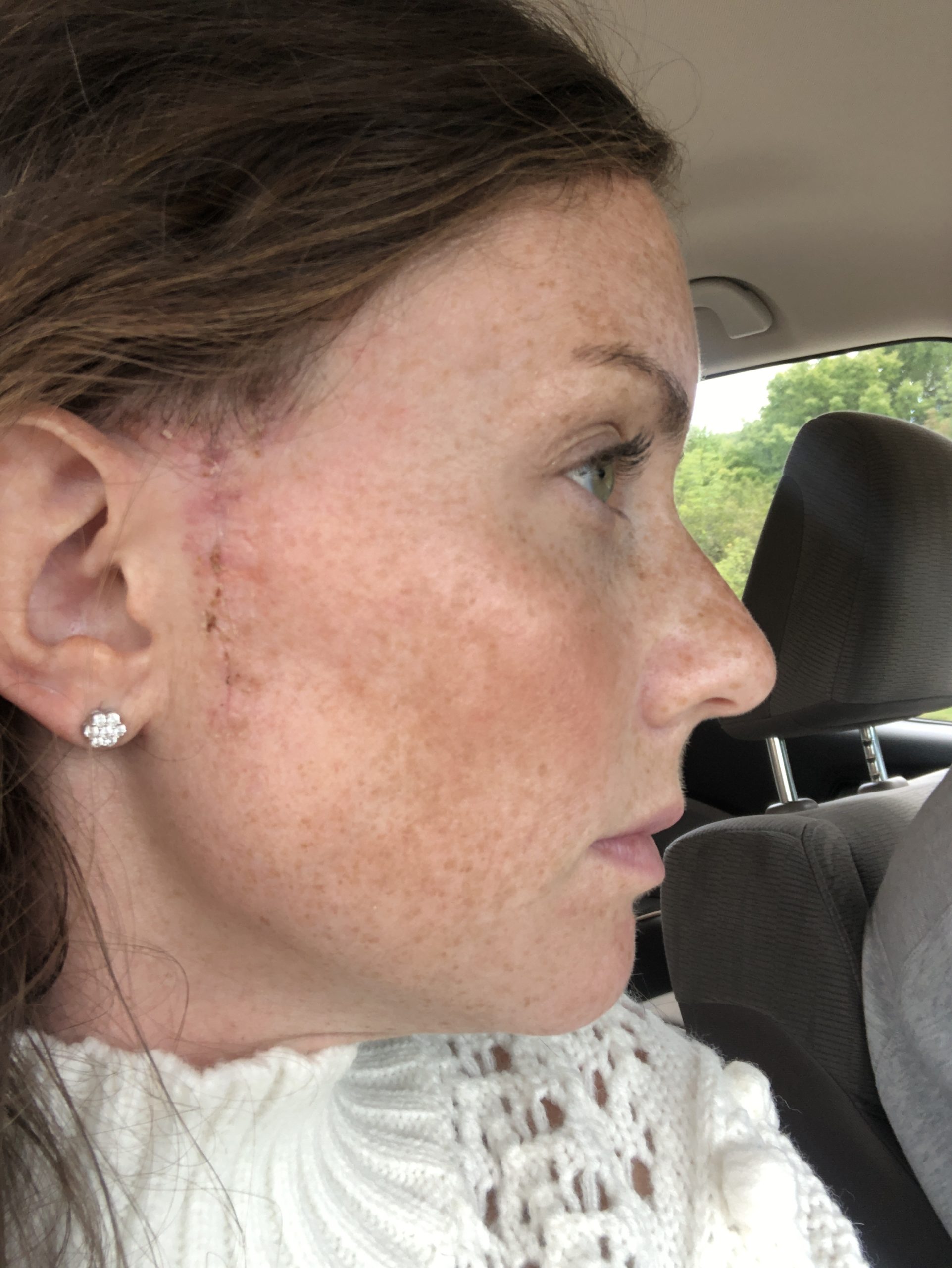 Scar after using Steri Strips from Mohs Surgery on Face