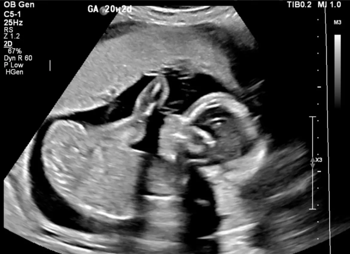 ultrasound baby 20 weeks 